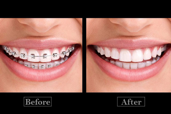حذف ارتودنسی دندان ها در فتوشاپ