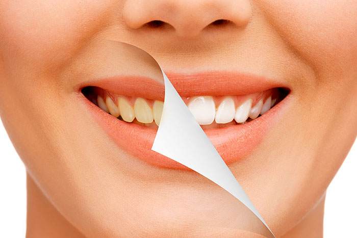 آموزش سریع سفید کردن دندان
