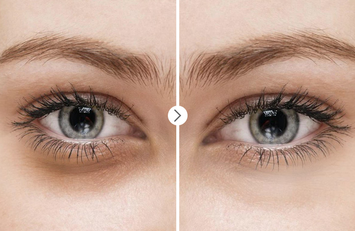 under-eye-blacks-remove